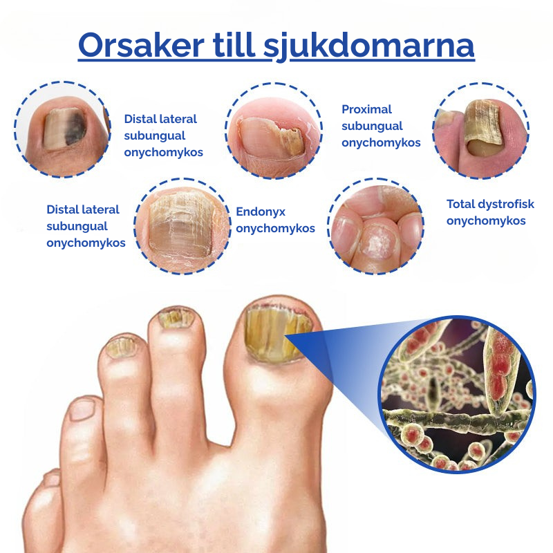 NailedIt™ | Apparat för laserbehandling av nagelsvamp