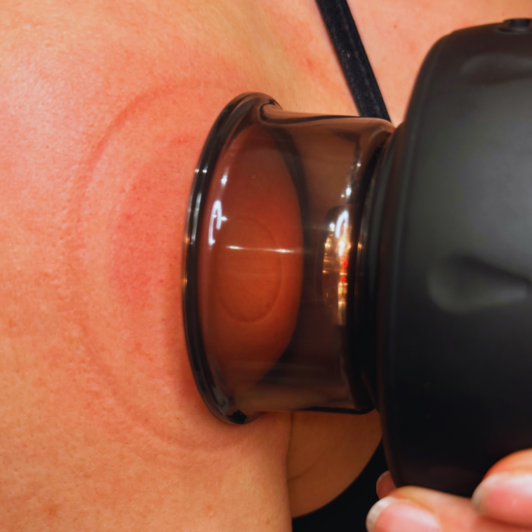 CupTerapi™ | En smartare lösning för smärta, stress och spända muskler!