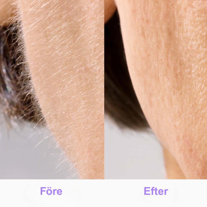 SilkRenew™ | Förnya din huds yta direkt – känn dig självsäker och ung igen