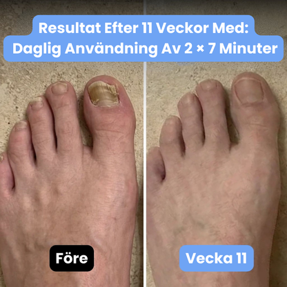 NailHeal™ | Ta bort envis nagelsvamp och återställ friska naglar