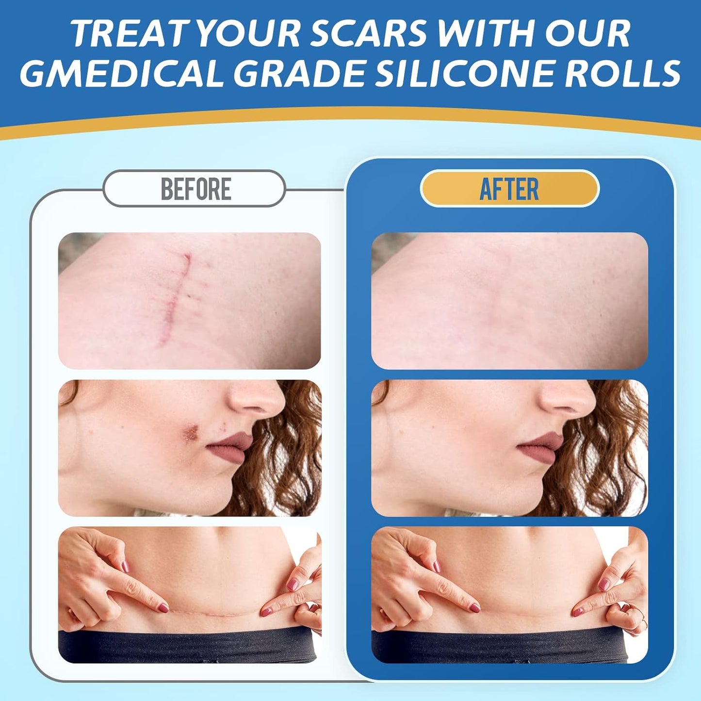 Ärrbort™ | Smidigt sätt att bleka ärr skonsamt och effektivt!