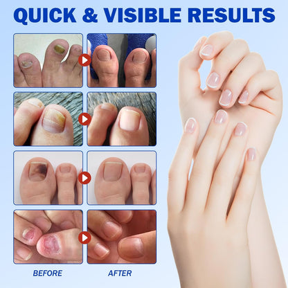 ClearNail™ | Säg hejdå till nagelsvamp — återfå en hälsosam glans
