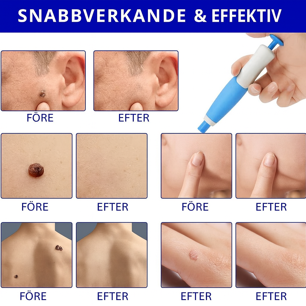 TagFree™ | Ta bort hudflikar enkelt – utan smärta, utan ärr, utan stress