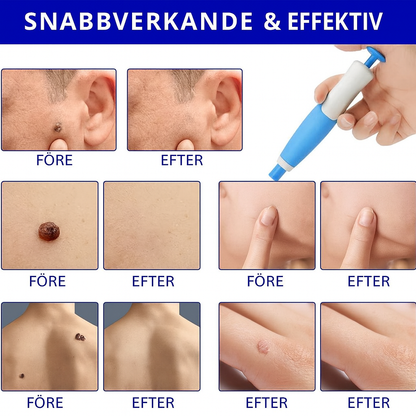 TagFree™ | Ta bort hudflikar enkelt – utan smärta, utan ärr, utan stress