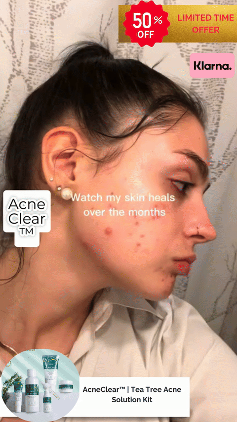AcneClear™ | Tea Tree Acne Solution Kit