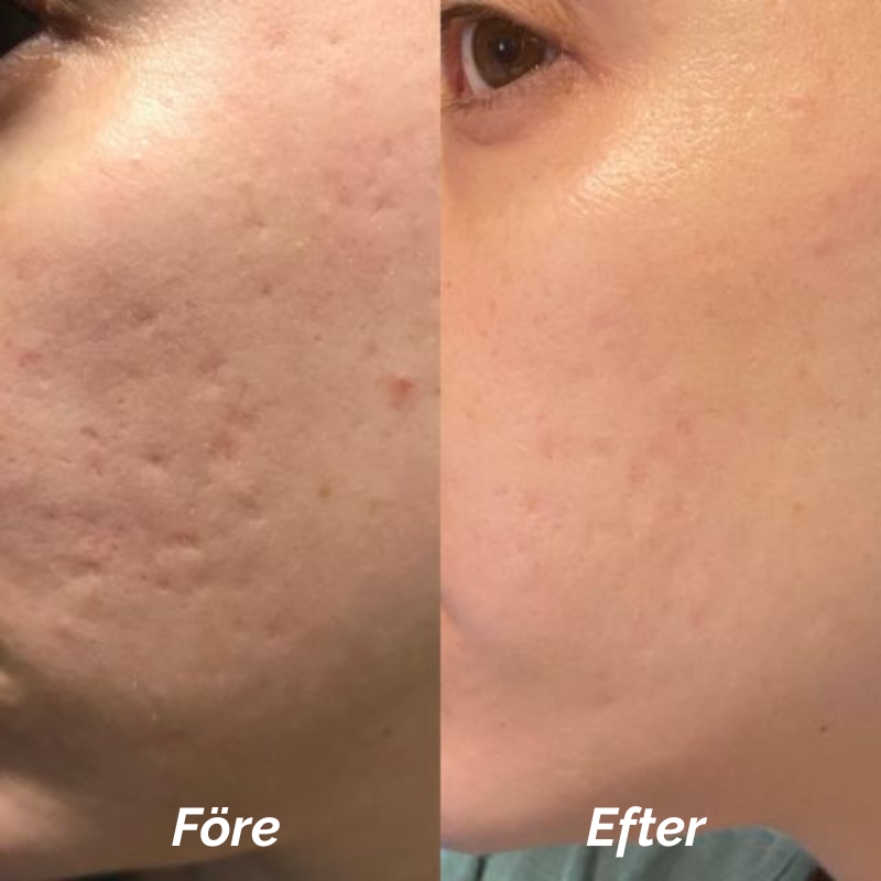 Ärrbort™ | Smidigt sätt att bleka ärr skonsamt och effektivt!