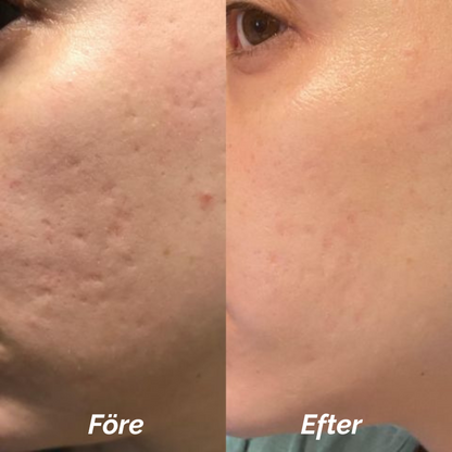 Ärrbort™ | Smidigt sätt att bleka ärr skonsamt och effektivt!