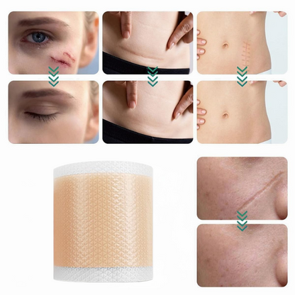 Ärrbort™ | Smidigt sätt att bleka ärr skonsamt och effektivt!