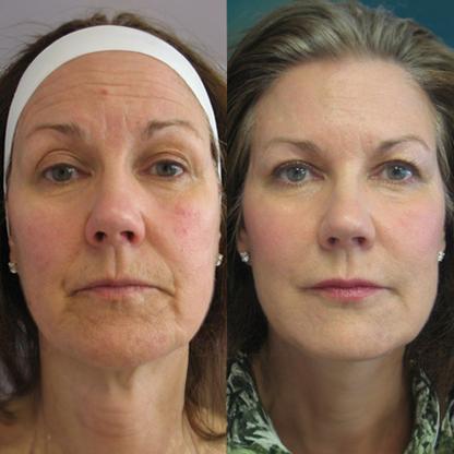 CollaPure™ | Mjukar upp fina linjer och lugnar rodnad – din huds lättnad på bara några minuter!