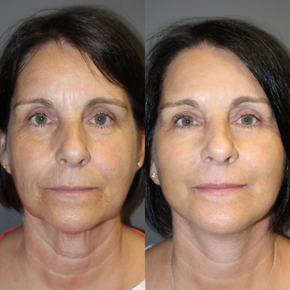 CollaPure™ | Mjukar upp fina linjer och lugnar rodnad – din huds lättnad på bara några minuter!