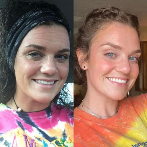 Ärrbort™ | Smidigt sätt att bleka ärr skonsamt och effektivt!