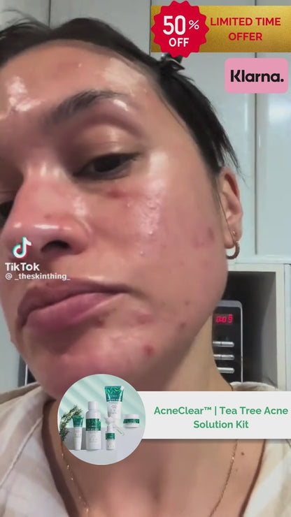 AcneClear™ | Tea Tree Acne Solution Kit