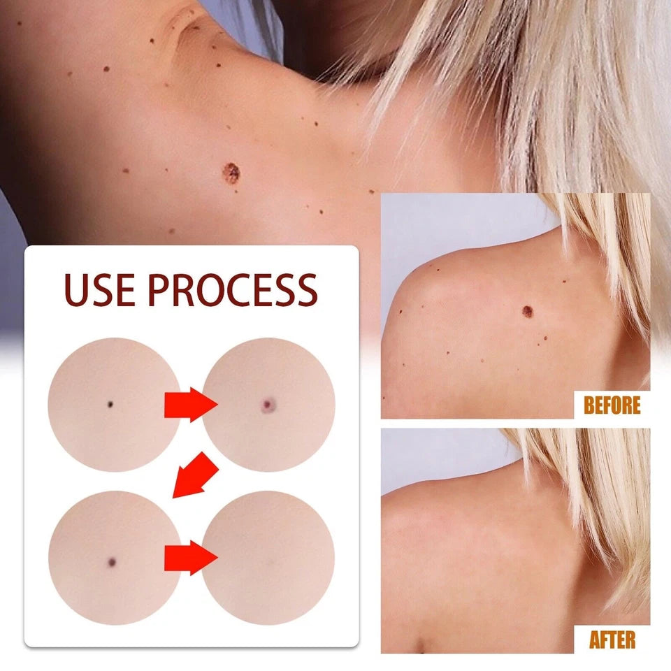 DermaLux™ | Eliminera vårtor och fläckar smärtfritt på bara 3 dagar