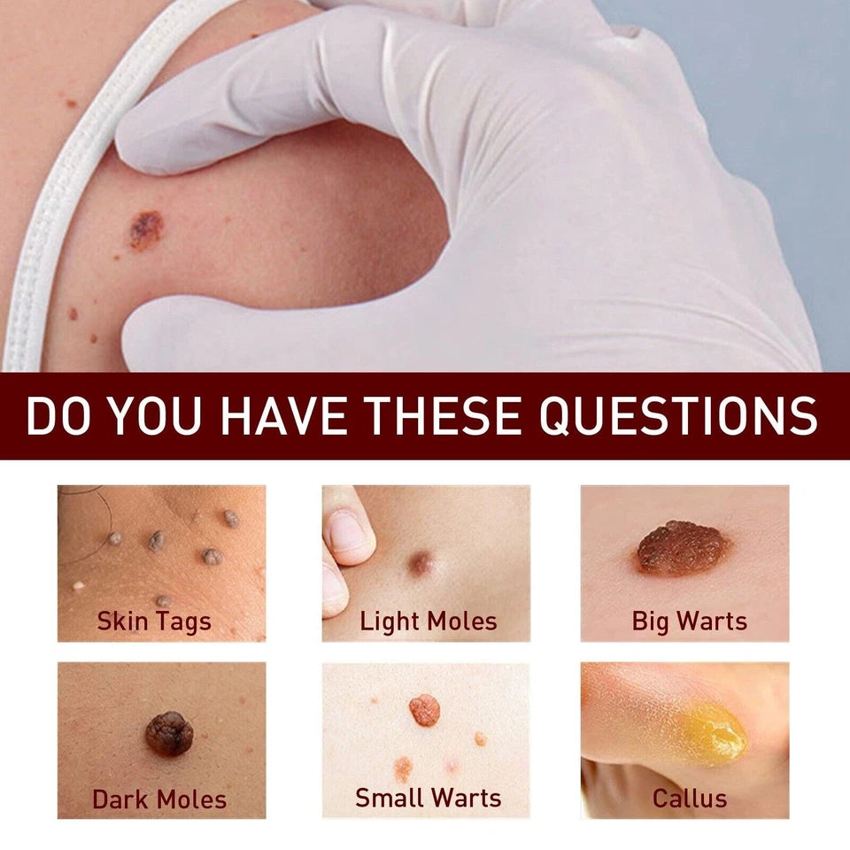DermaLux™ | Eliminera vårtor och fläckar smärtfritt på bara 3 dagar